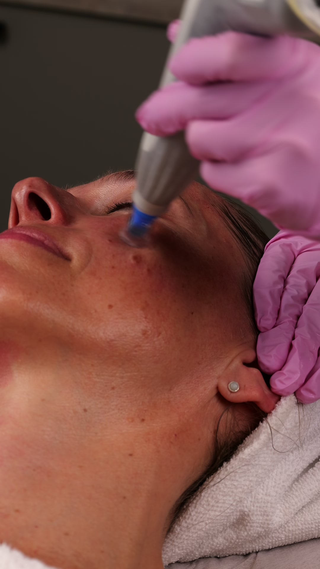 Hudterapeut utför Dermapen-behandling