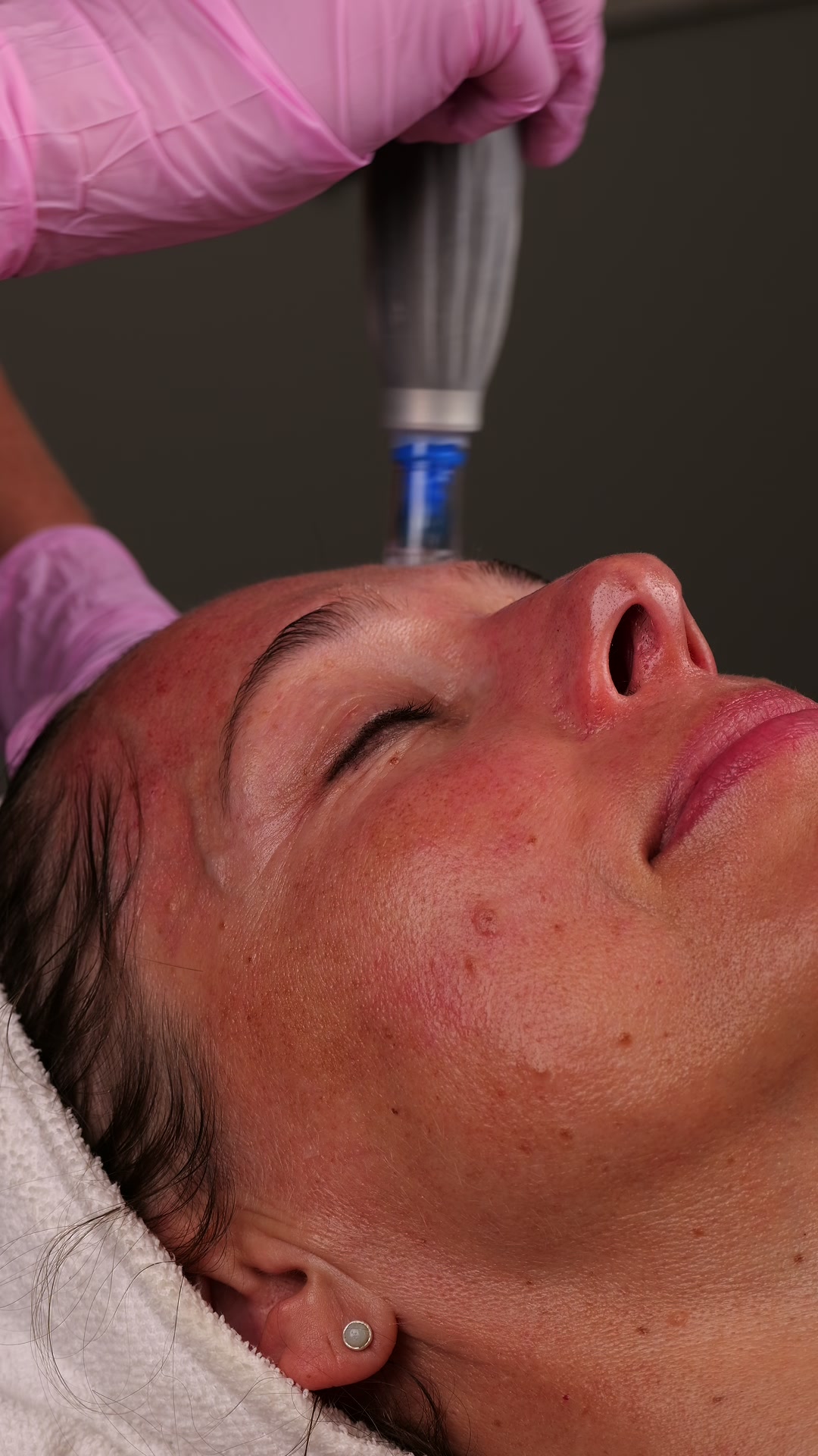 Dermapen 4 microneedling-behandling av ansikte
